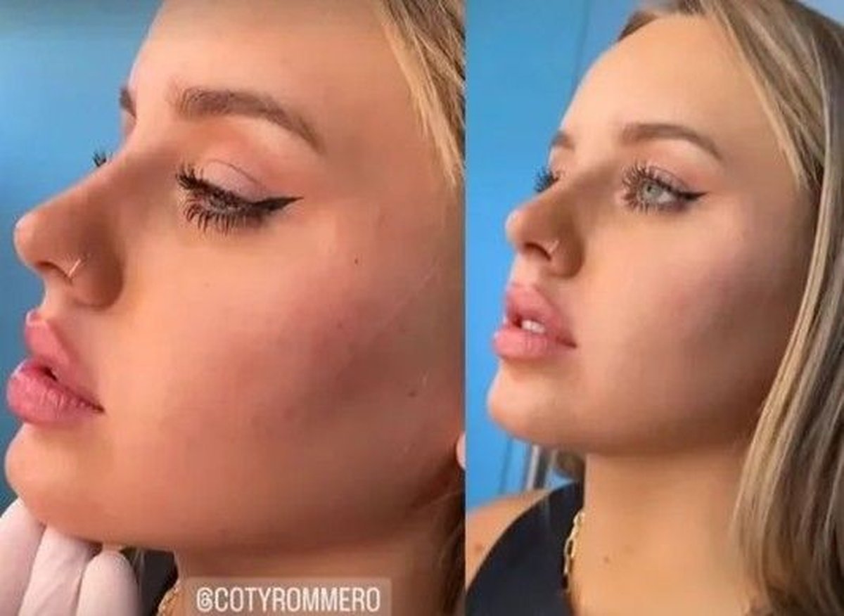 El antes y despu&eacute;s tras el retoque est&eacute;tico facial que se hizo la ex Gran Hermano.  